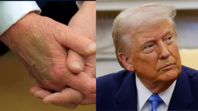 (Photo: X) 'They are trying to hide...': Medical experts weigh in on Trump’s 'bruised' hand; press sec dismisses speculations