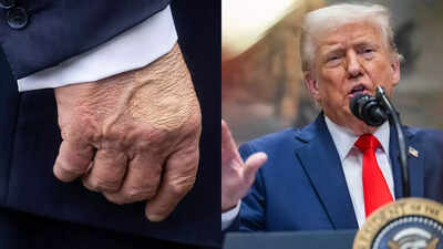 Trump’s health drama: Mystery bruise and swollen ankles - What the White House isn’t saying