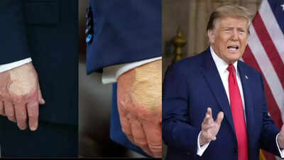 Unseen Bruises Covered By Makeup Fuel Fresh Doubts About Trump’s Health And Mental Sharpness Unseen Bruises Covered By Makeup Fuel Fresh Doubts About Trump’s Health And Mental Sharpness
