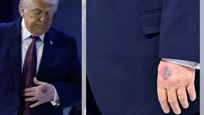 Row over Trump’s hand bruise in Davos and ‘missing medical records’: ‘Two years of coverage of Biden’s health…’