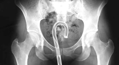 Federal injury data logged shampoo bottles, lightbulbs and vape pens removed during emergency room visits in 2025/ Image: Defector US government releases list of unusual objects surgically removed from people's rectums in 2025