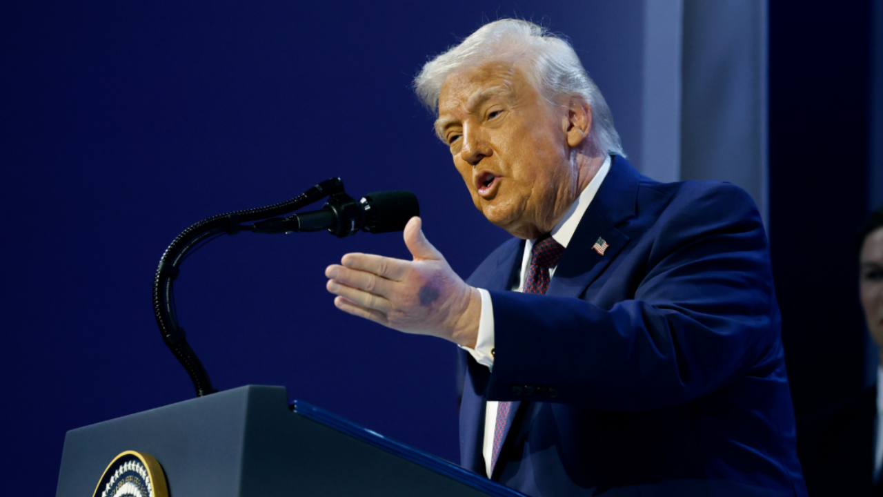 Trump says his bruise is due to shaking hands with people he meets.