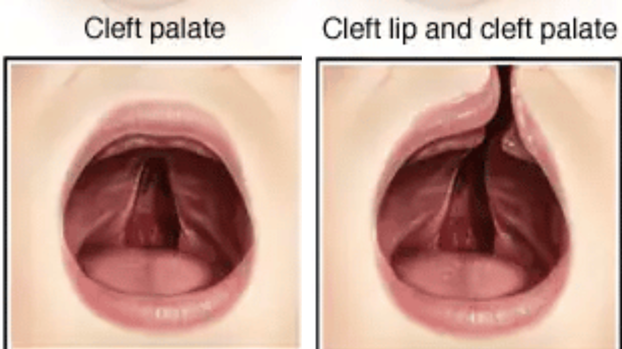 Cleft Palate